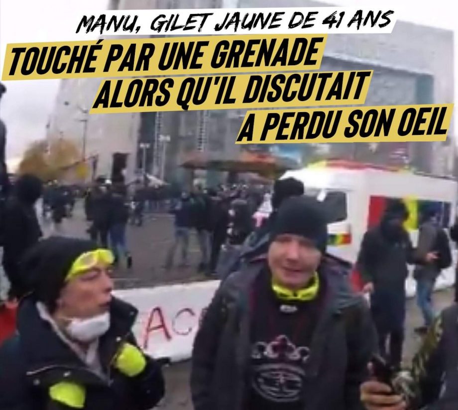 Manu, Gilet Jaune touché à la tête par une grenade, a perdu son œil