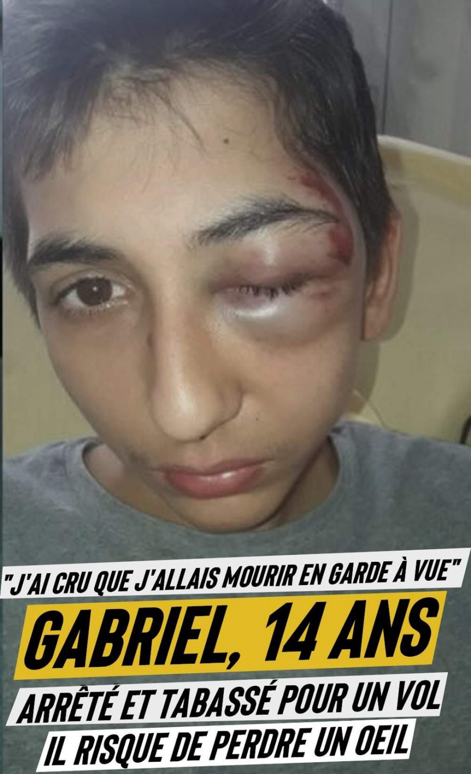 Gabriel, 14 ans : tabassé au sol par la police, il risque de perdre un œil
