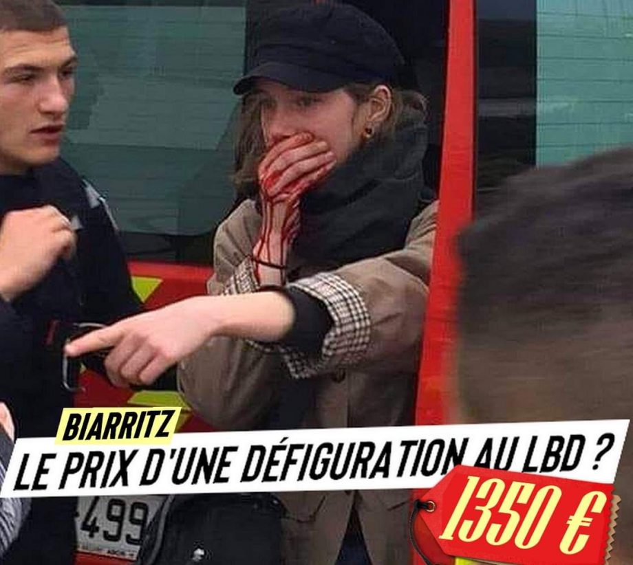 Le prix d’une défiguration par la police ? 1350 euros !