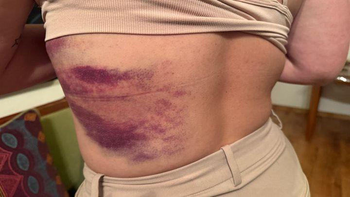 Le dos d'Albane Buriel, passée à tabac par des colons israéliens, présente des marques de son soutien à la Palestine.