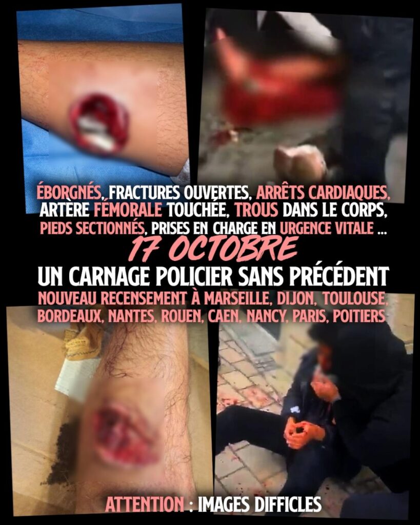 Quelques-unes des blessures d'une gravité sans précédent infligées ce 17 octobre par la police française à sa population.