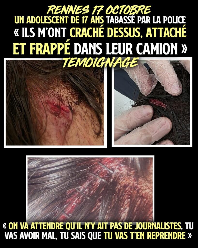 Les plaies sur le crâne de l'adolescent tabassé par la police à Rennes