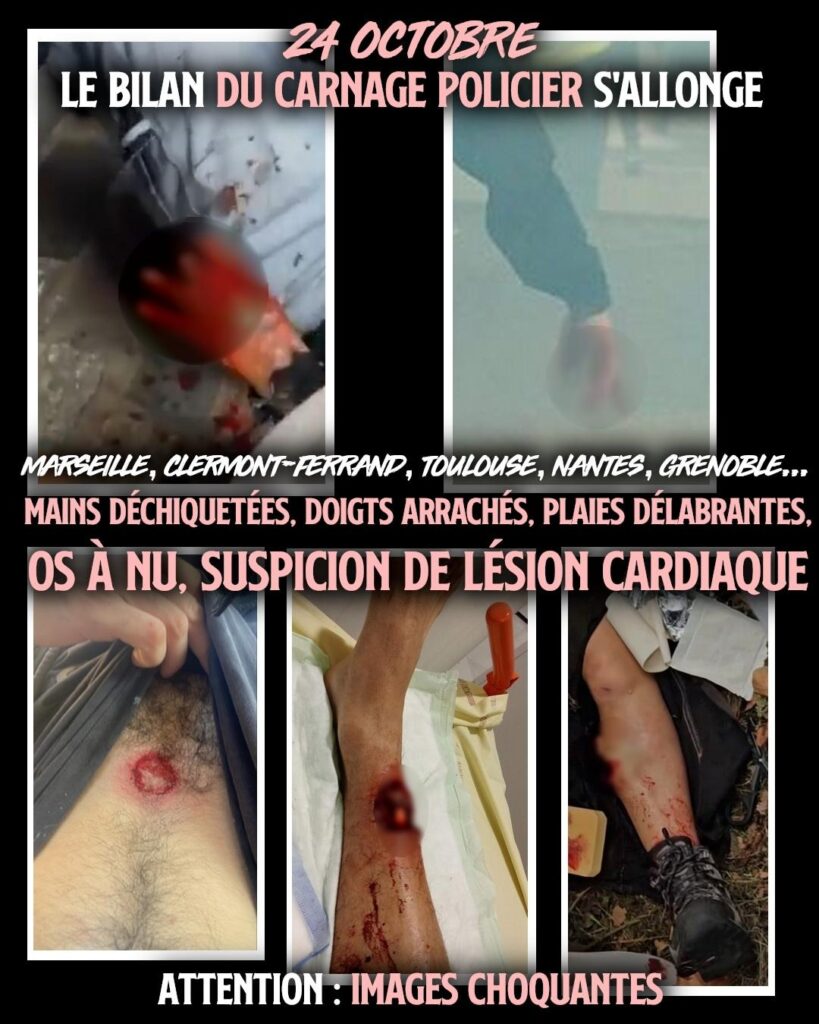 Quelques unes des terribles blessures infligées par la police en ce mois d'octobre.